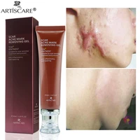 scar acne removal gel cream stretch marks pimples spots blackhead treatment whitening moisturizing smooth body skin care 30g