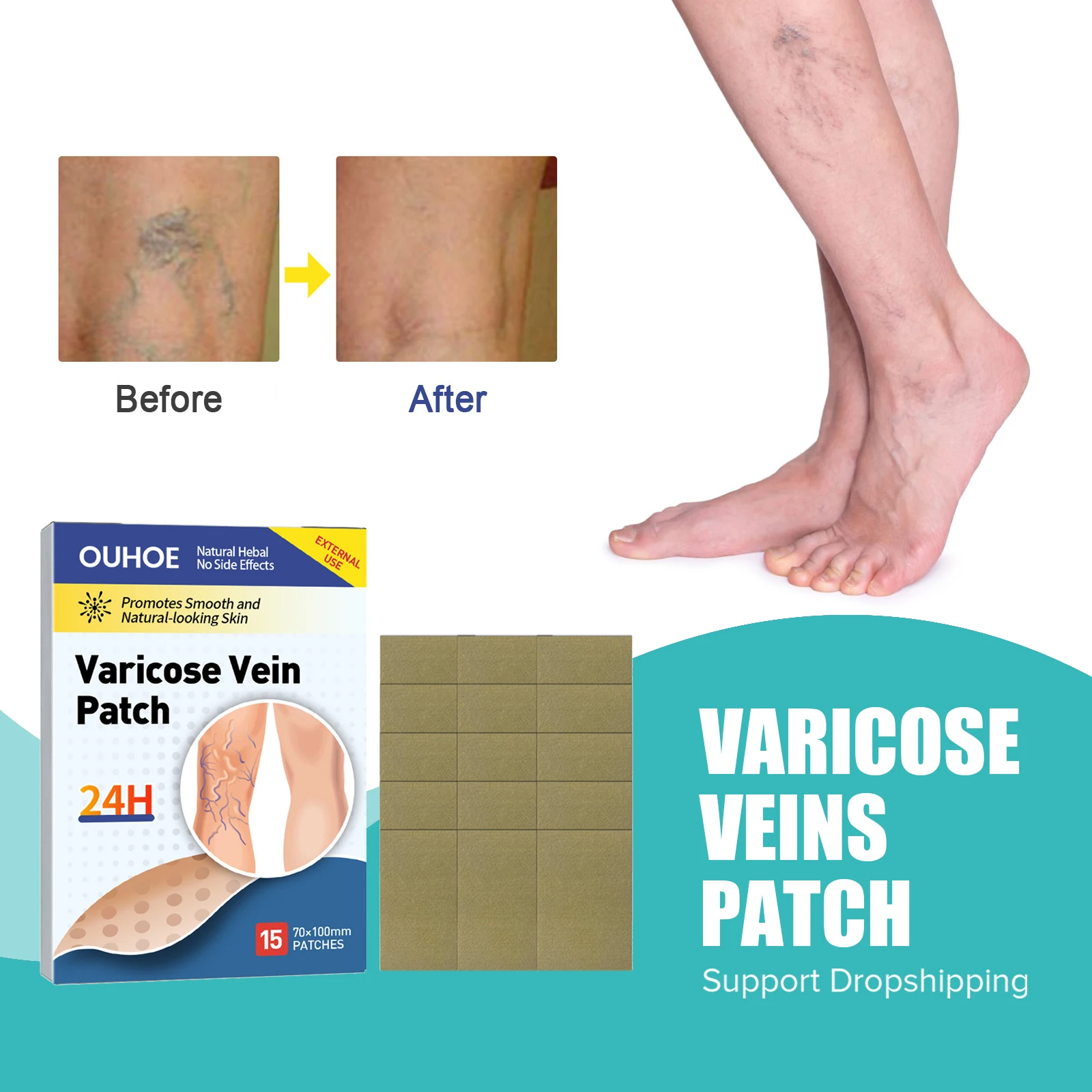 

Varicose Veins Patch Relieve Leg Vasculitis Phlebitis Spider Pain Medical Plaster Improve Blood Angiitis Removal Vein Treatment