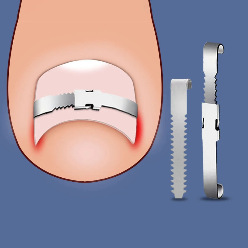 Средство для восстановления вросшей зоны ног инструмент ухода за ногтями