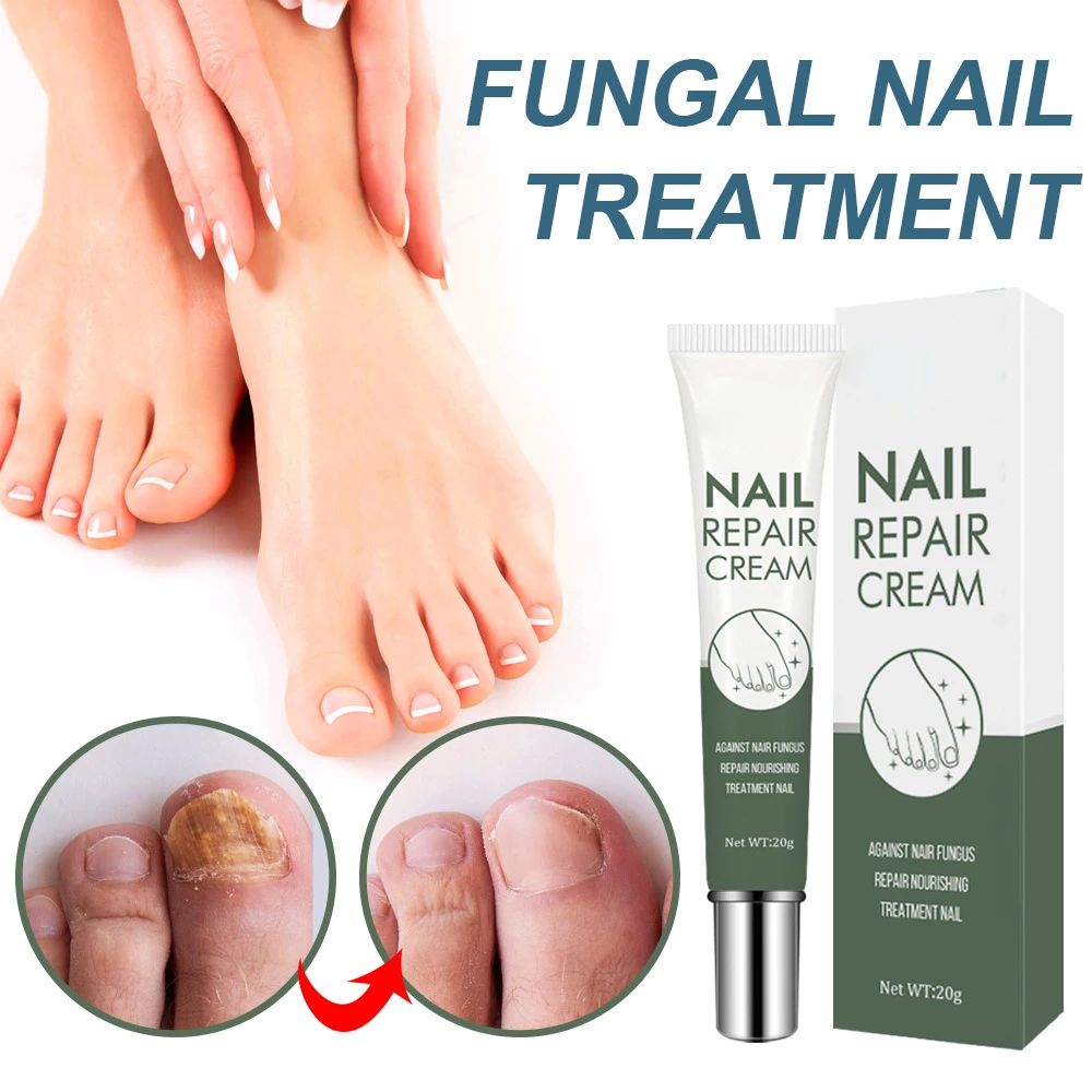 20g Nail Repair Cream Painless Removal Anti Onychomycosis Paronychia Foot Care Treatment Antifungal Toe Fungus Repair Cream