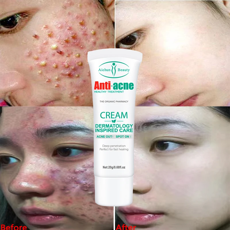Herbal Acne Removal Face Cream Anti-Acne Treatment Pimple Scar Removal Gel Shrink Pores Oil Control Moisturize Repair Skin Care
