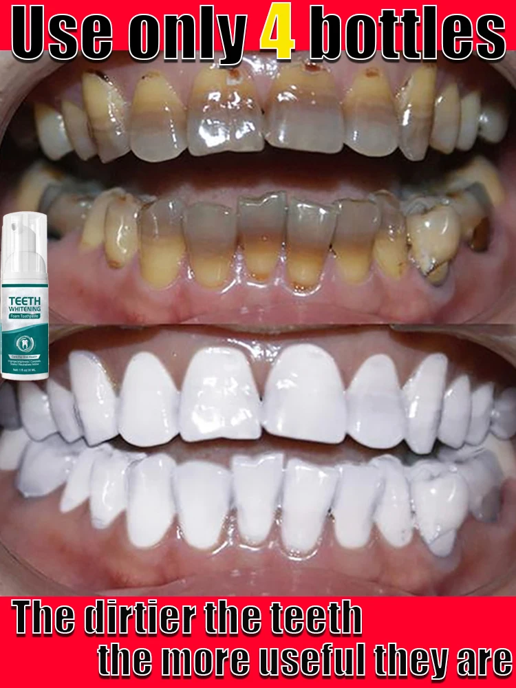 

Teeth Whitening Mousse Dental Care Essence Remove Plaque Tooth Stain Gingival Repair Caries Prevention Oral Cleaning 30ml