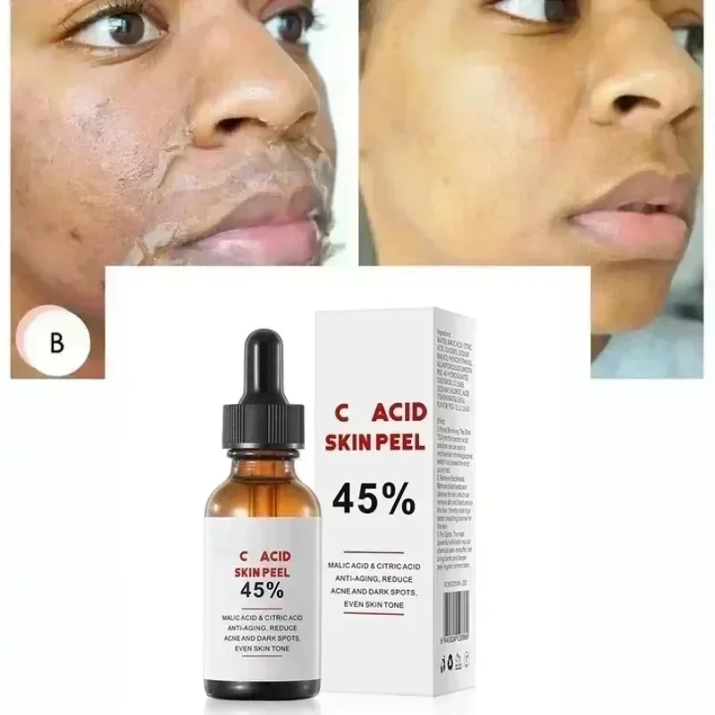 Лидер продаж кислотно-пилинг сыворотка-масло очищающее средство для лица