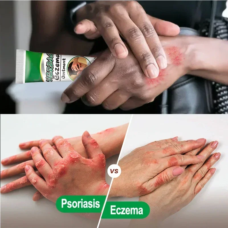Крем от псориаза лечение дерматита экзематоида зуда мазь против