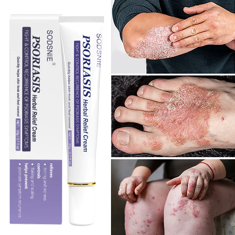 

Psoriasis Herbal Relief Cream Repair Dermatitis Eczematoid Anti Fungal Effective Itch Improve Scaly Redness Treatment Ointment