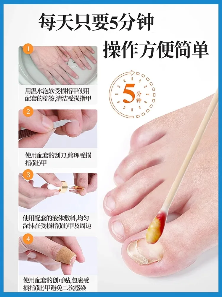 [Watsons Hot Sale] It Is Invalid to Remove 99% Gray Potassium Fungus without Packing Or Repairing a Drop!!!