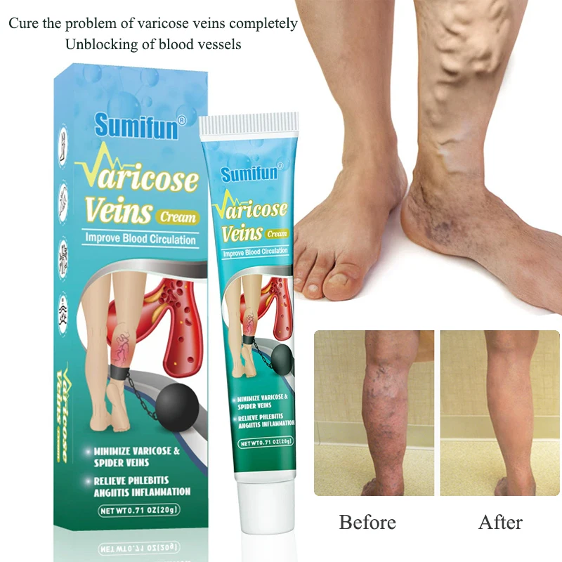 

Varicose Veins Cream Leg Vasculitis, Phlebitis, Spider Shape Treatment, Vein Varicose Veins Removal Cream for Angiitis Removal
