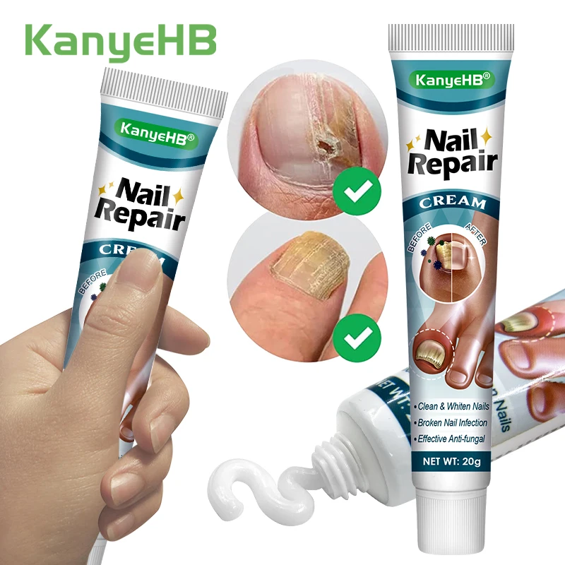 1/3/5/7 шт. травяная мазь для удаления грибка на ногтях