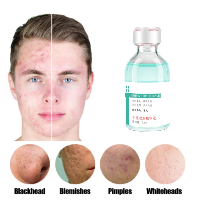 

Control Shrink Pores Whitening Essence Remove Dark Spots Blackheads Cherry Blossom Facial Serum Repair Facial Acne Pimple Care
