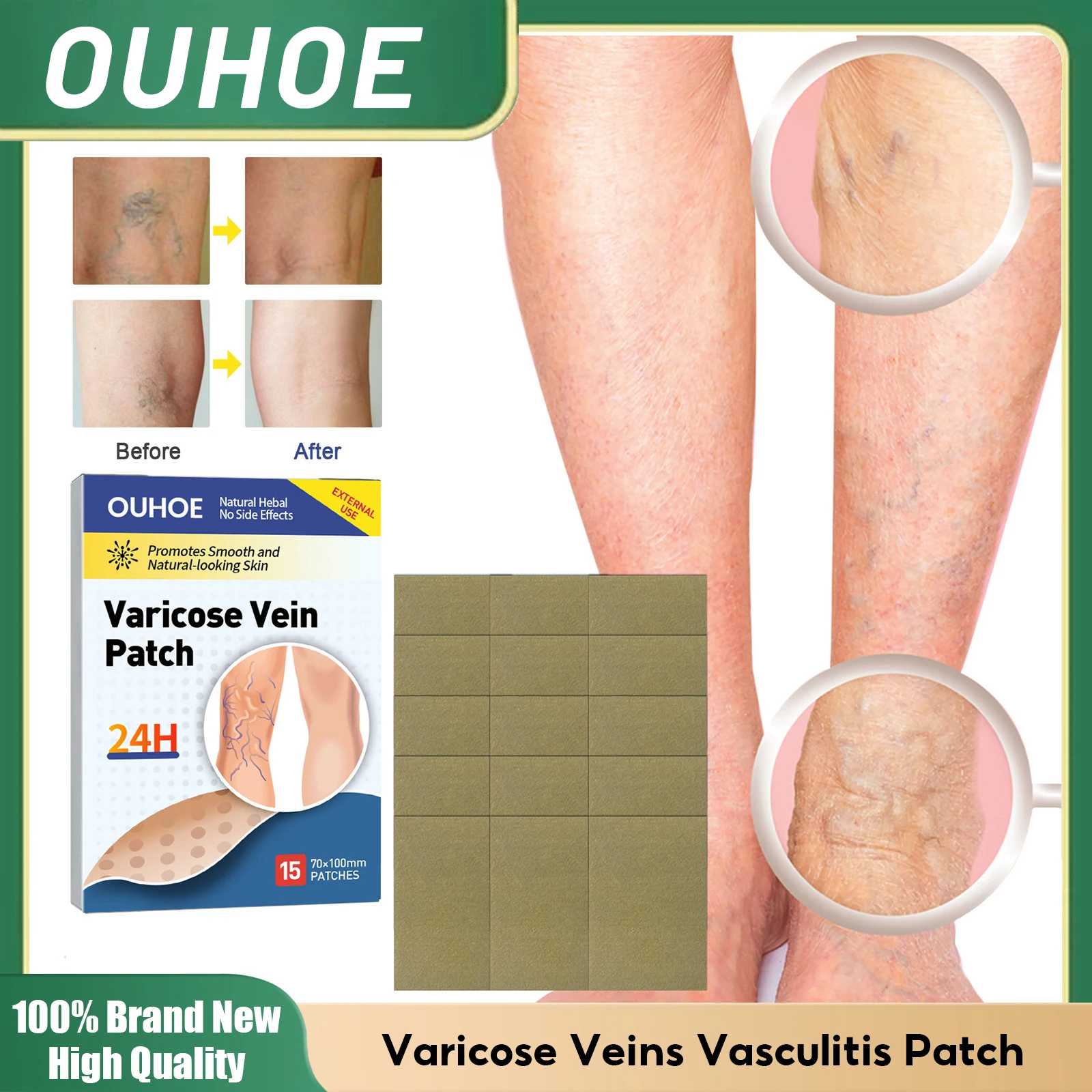 

Varicose Veins Vasculitis Patch Vascular Veins Remover Treatment Blood Vessel Spider Legs Anti-swelling Herbal Medical Plaster