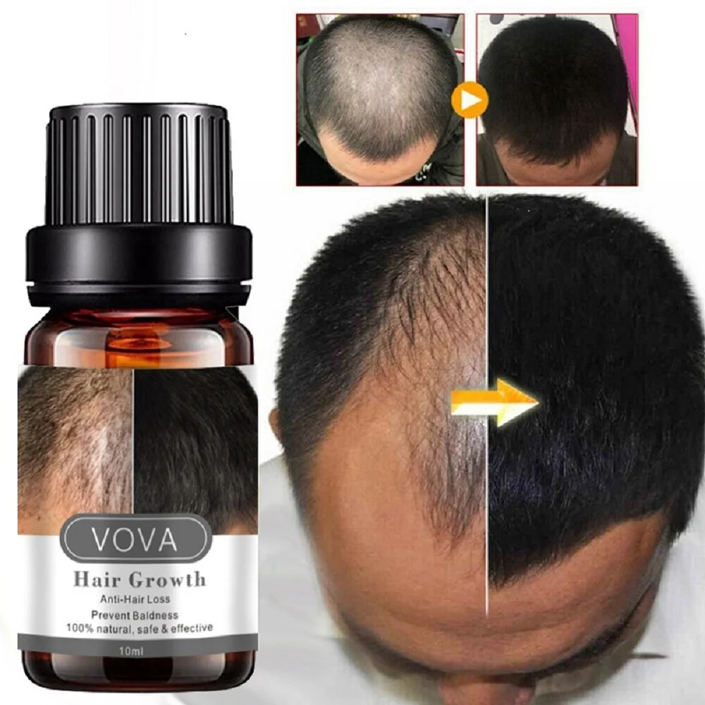 Hair Growth Essential Oil Products Natural Anti Hair Loss Treatment Nourishing Scalp Damaged Hair Repair Beauty Health Care