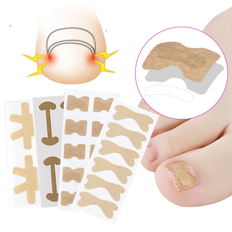 

4-20Pcs Ingrown Toenail Corrector Sticker Paronychia Treatment Recover Corrector Bunion Pedicure Foot Ingrown Toe Nail Stickers
