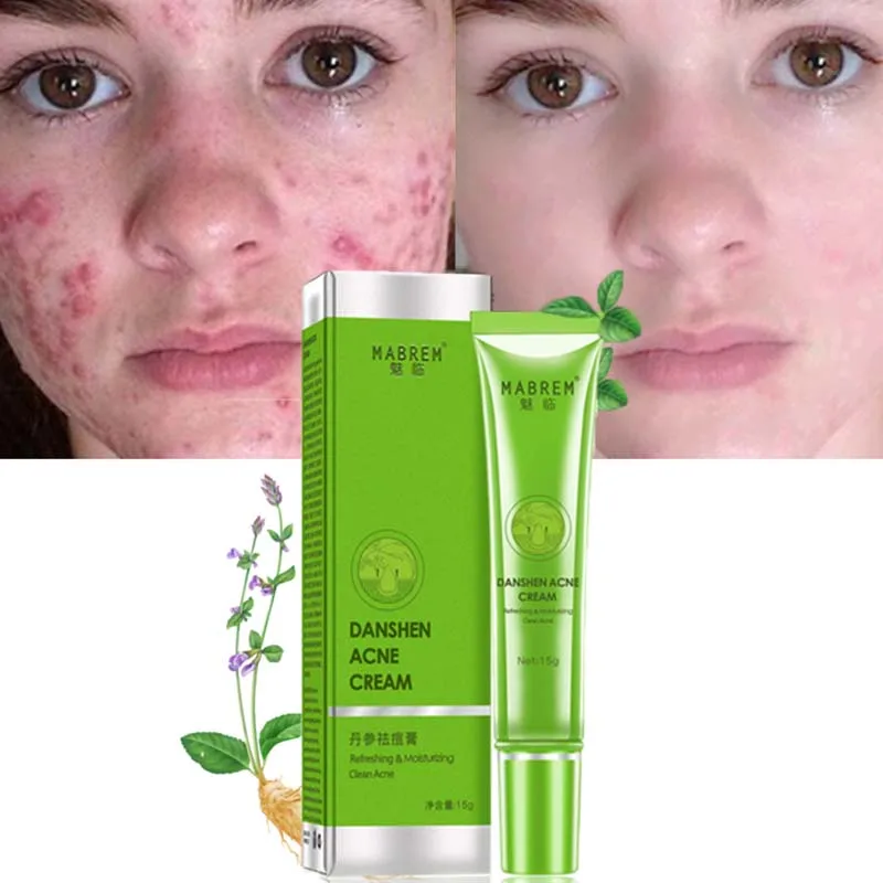 

Acne Removal Cream Aloe Oil Control Gel Shrink Pores Anti-aging Black Dots Acne Pimple Treatment No Stimulation Face Skin Care