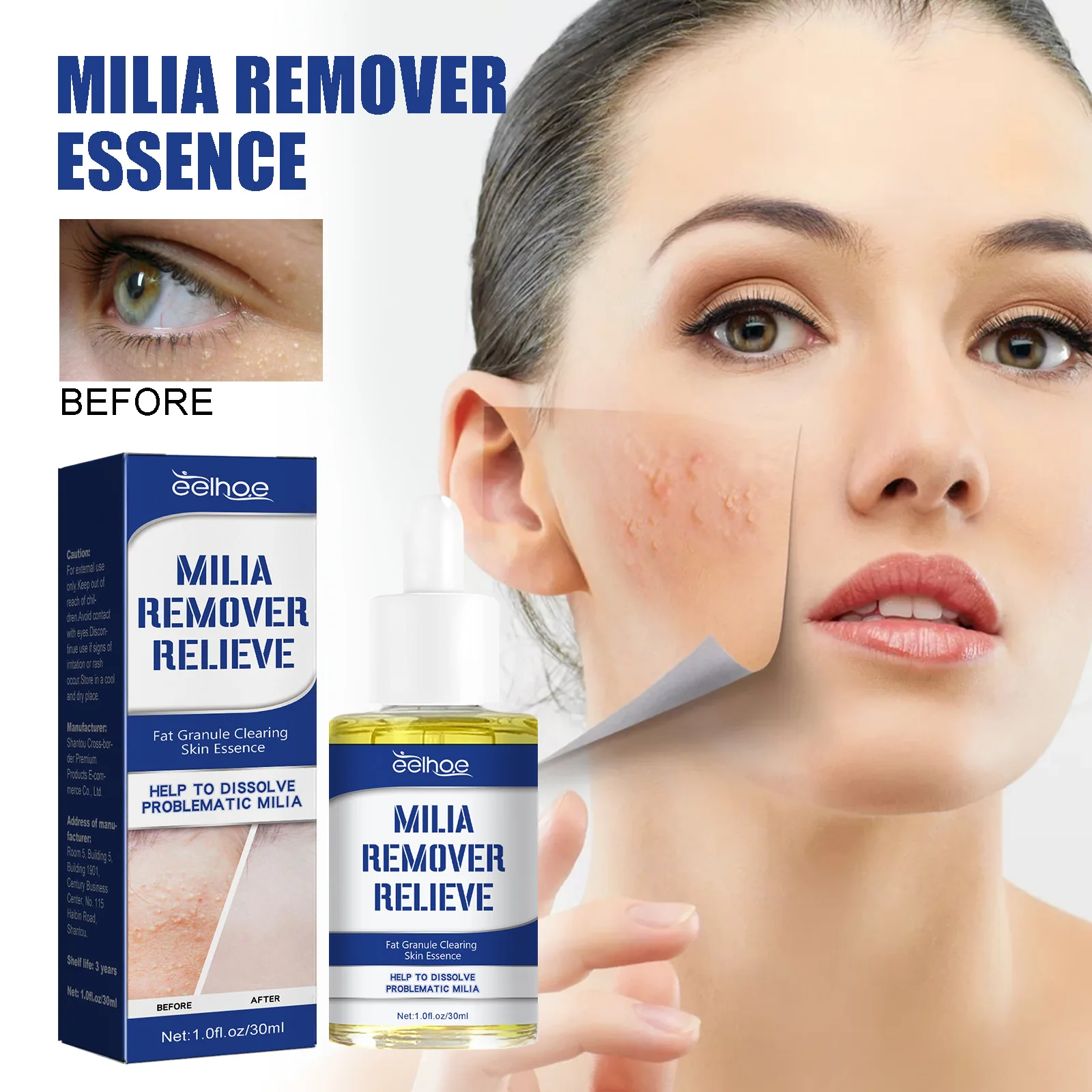 

EELHOE Remover Fat Granule Clearing Skin Essence Relieve Fat Particles Treatment Repair Skin Balance Oil Dispell Millet Eruption