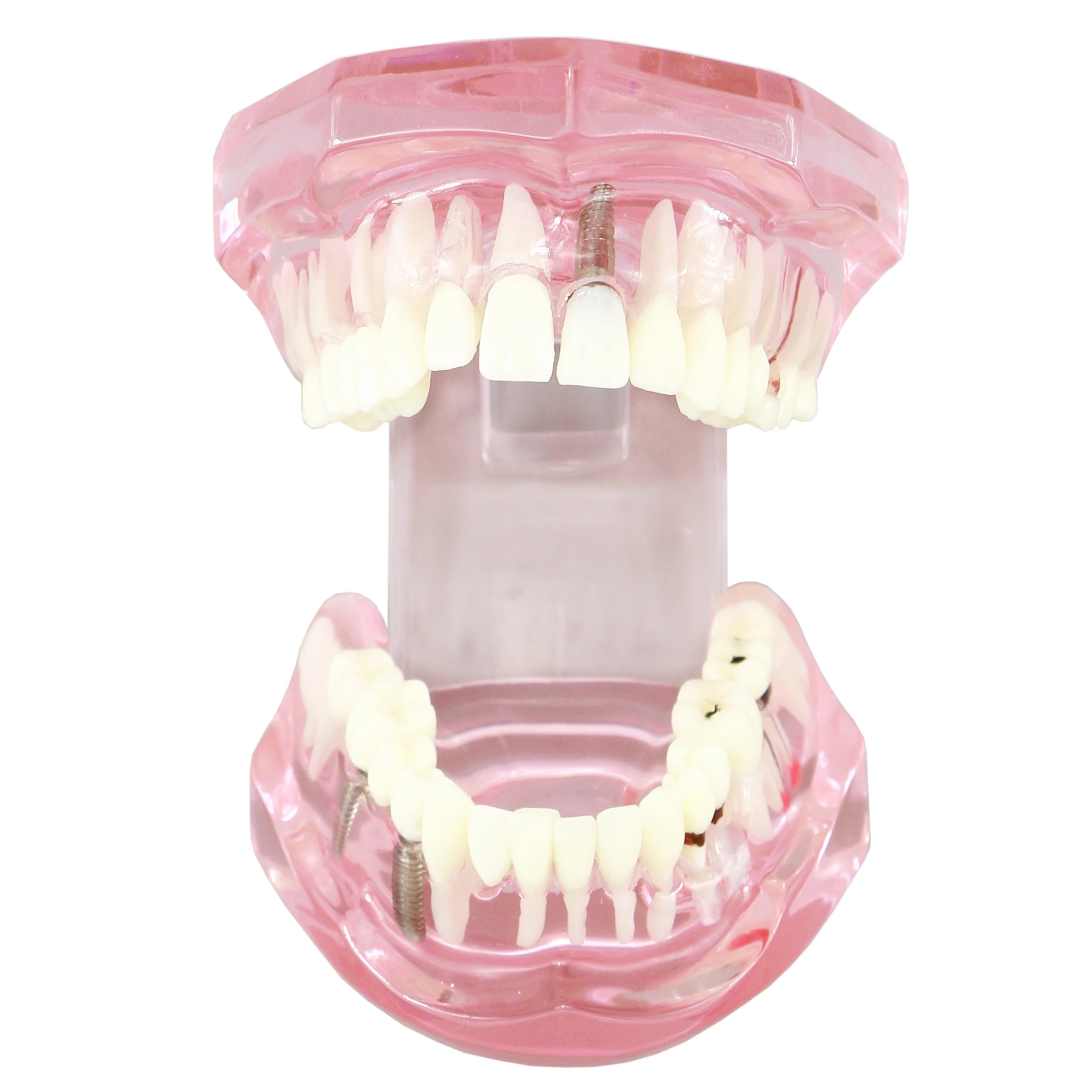 

Dental Teeth Model Typodont Implant Restoration Bridge Demo M2001 Pink Clear Teach Study Oral Pathology For Teach Study