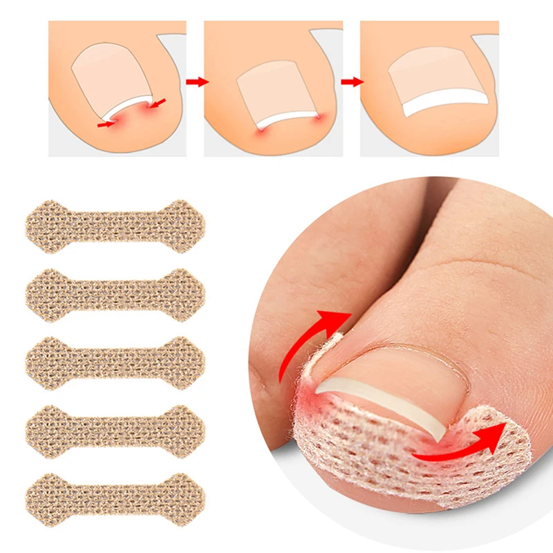 

4/10 Sheets Pedicure Ingrown Nail Tool Toenail Stickers For Nail Corrector Paronychia Treatment Fixer Recover Bunion Feet Care