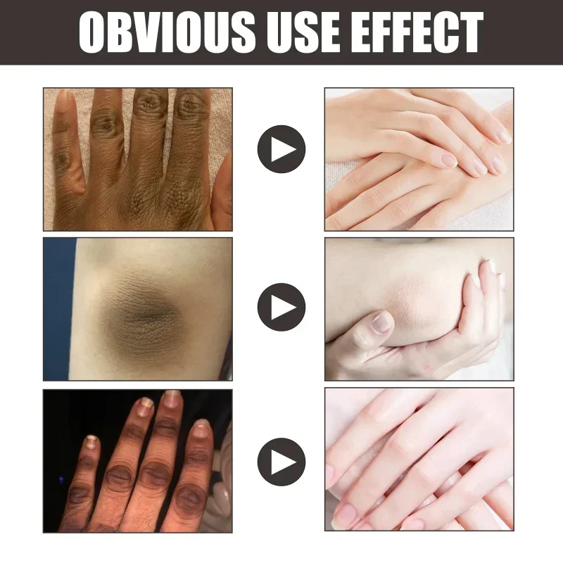 Отбеливающий крем Sdotter для суставов тела подмышек ног коленей локтей Осветляющий