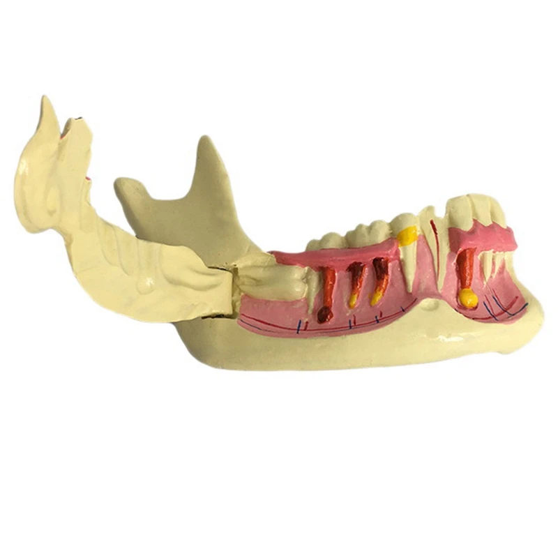 

Endodontic Treatment Model Anatomy Of Gums Study Teach Teeth Model Adult Pathology Model