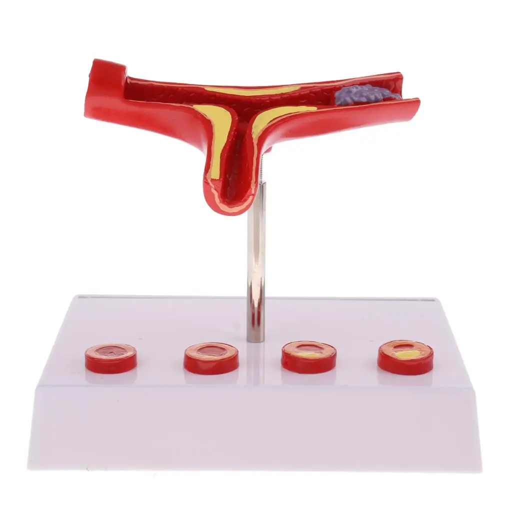 Увеличение 50x -секция человеческого сосуда Атеросклероз Тромб Сосудистый