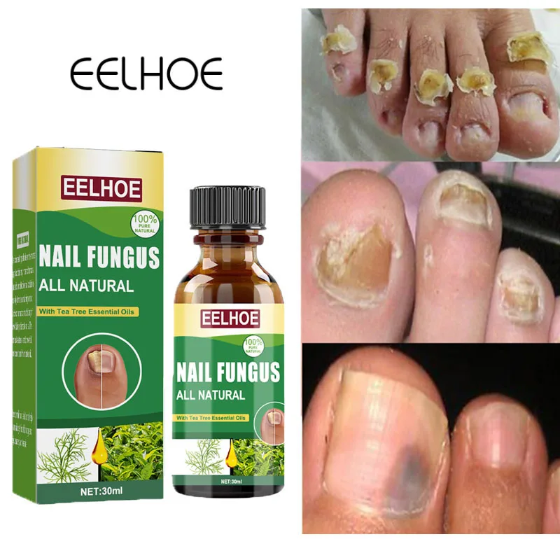 

Средство для лечения грибков ногтей, сыворотка для ухода за ногами, восстановления ног, ногтей на ногах, гель для удаления грибка, противоин...