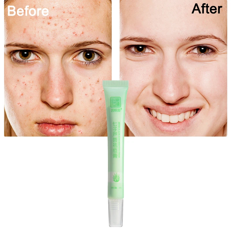 Rungenyuan aloe vera gel acne removal products 10g  hidratante y alivia los poros pimple marks removal  melatonin face serum