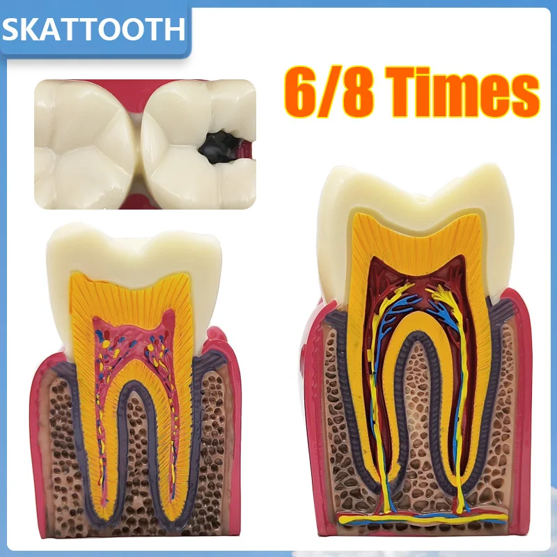 Модель кариеса Стоматологическая 6X 8X модель для сравнения обучающая общения