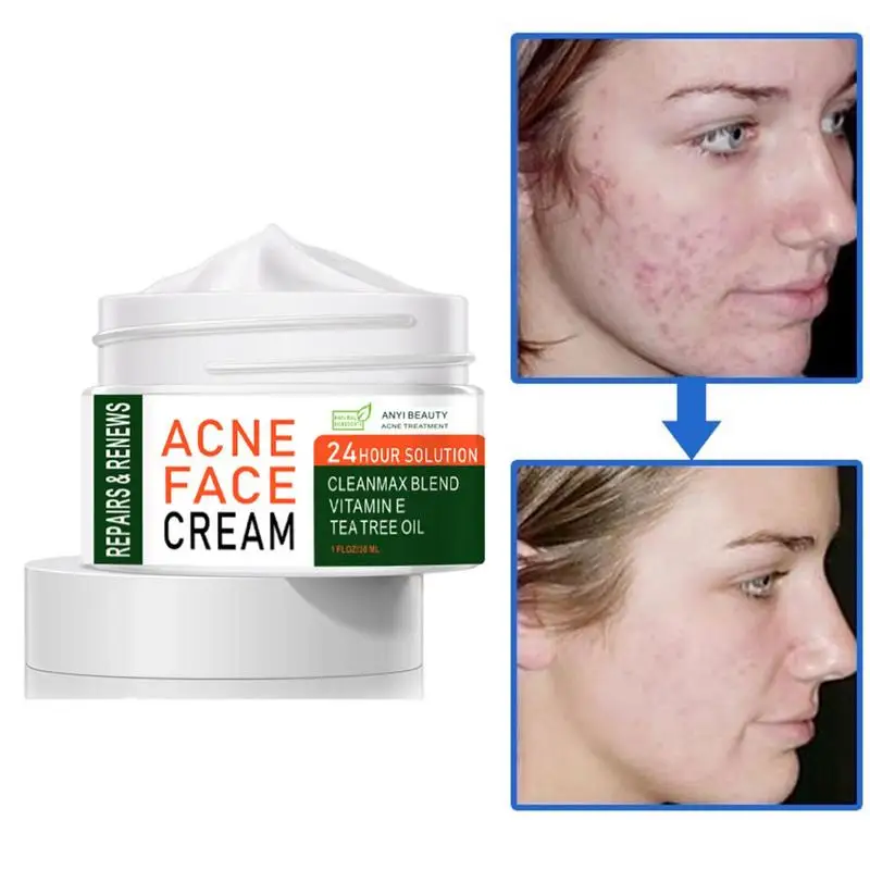 

Крем для удаления акне, крем для удаления шрамов от акне для мужчин и женщин