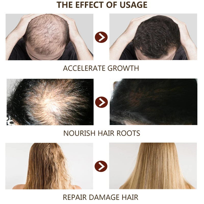 Имбирный спрей для роста волос эфирное масло раньше истончения сухая эссенция