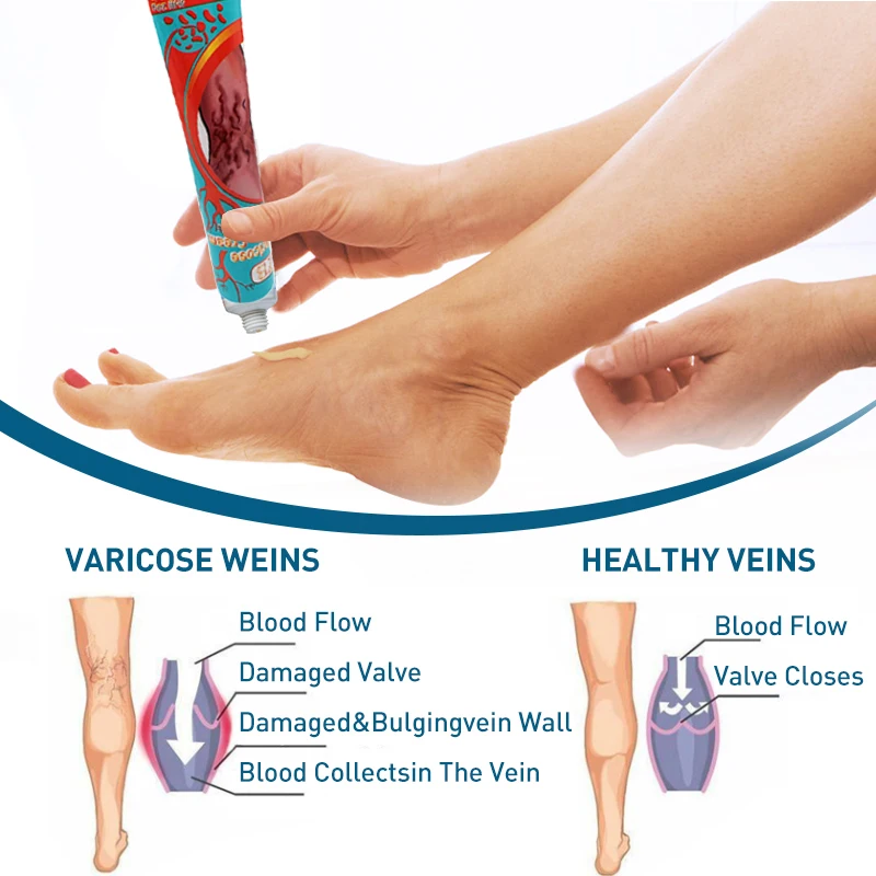 

5PCS 20g Varicose Veins Ointment Phlebitis Earthworm Vein Dressing Legs Vasculitis Swollen Blood Vessels Analgesics Cream