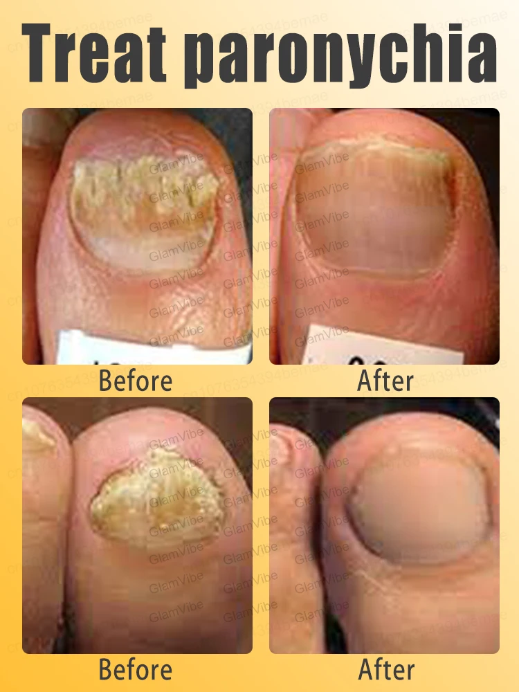 Деформированный терминал для ногтей Немезида кровотечения вросших