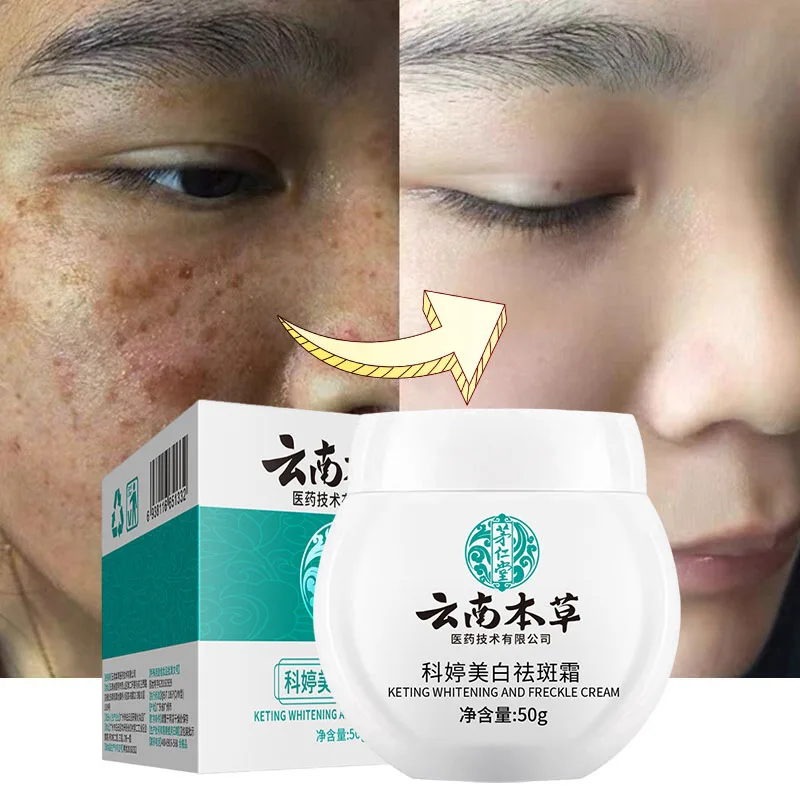 

Whitening Freckle Face Cream Dark Spots Remover Fade Melanin Melasma Improve Dull Anti-aging Brightening Moisturizing Skin Care