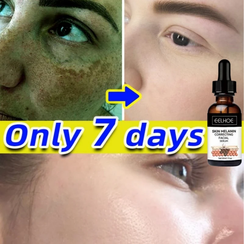 

Whitening Freckle Serum Fade Melasma Dark Spots Remove Pigment Melanin Corrector Brighten Beauty Skin Care Korea Comestics 30ml