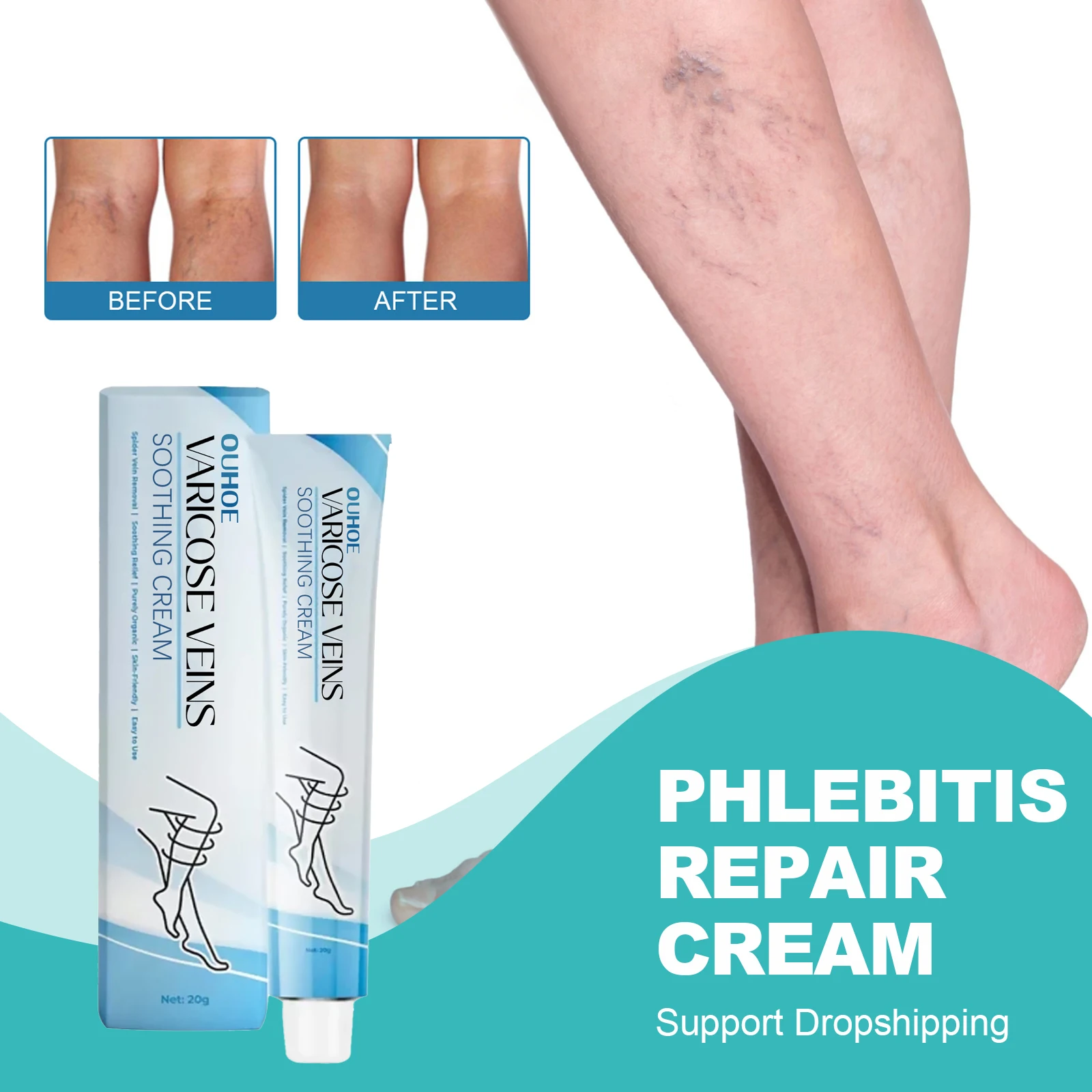 

Varicose Veins Ointment Relieve Legs Dilated Phlebitis Angiitis Inflammation Blood Vessel Spider Vasculitis Treatment Cream 20g