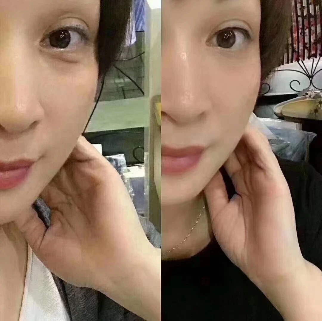 Многофункциональная плазменная ручка для подтяжки век и морщин CE 2023