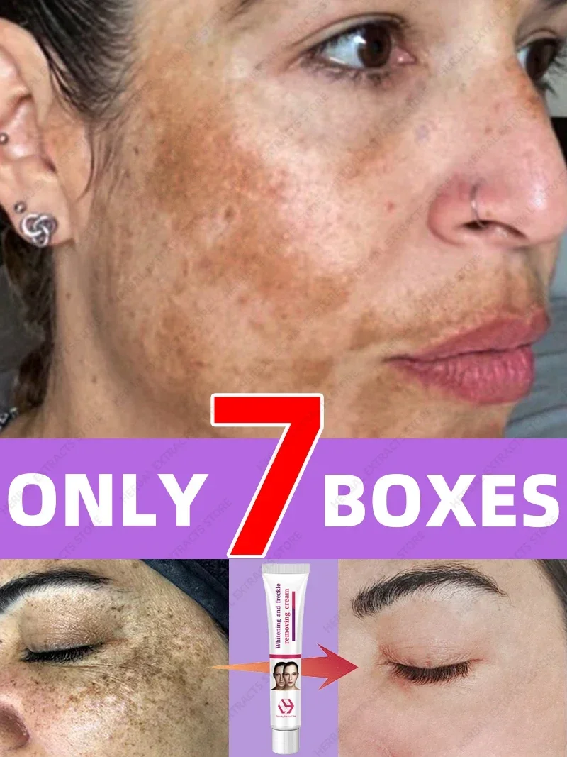 Хлоазма веснушки солнце темные пятна уменьшаются