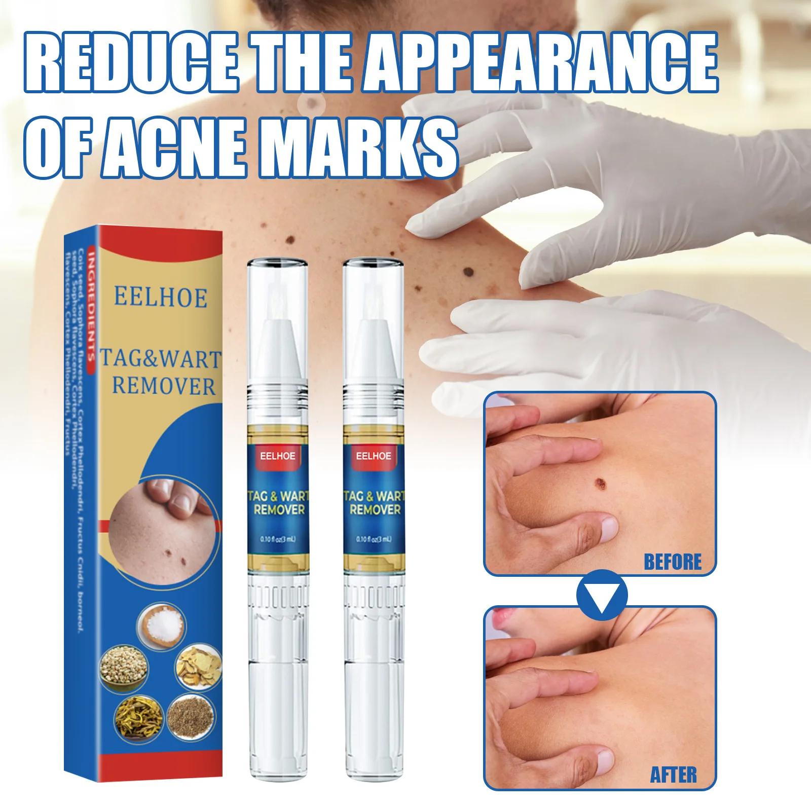 

Skin Moles Removing Pen Body Skin Warts Removing Lotion Dispel Wart Degreasing Granule Moles Removal Go To Corns