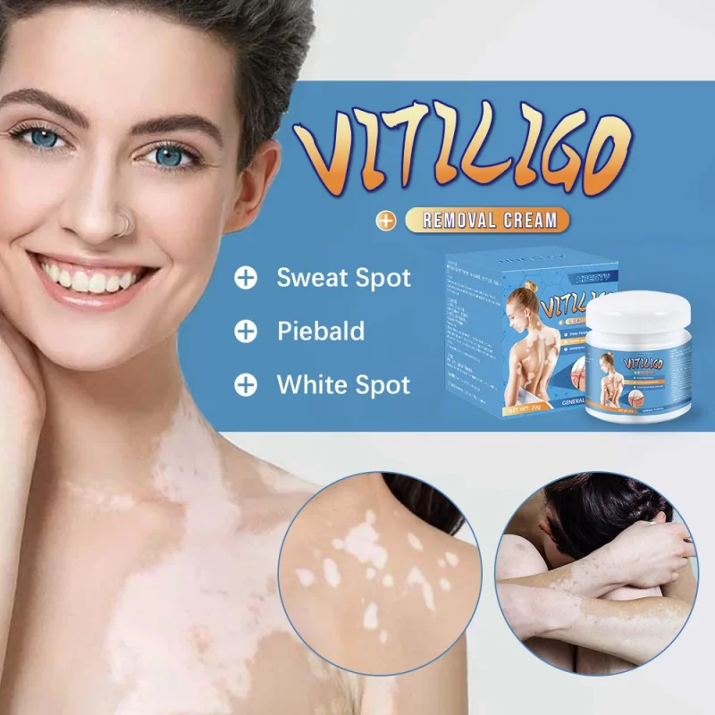 Мазь HBESTY Vitiligo для удаления черных точек эффективное удаление кожи ухода за кожей