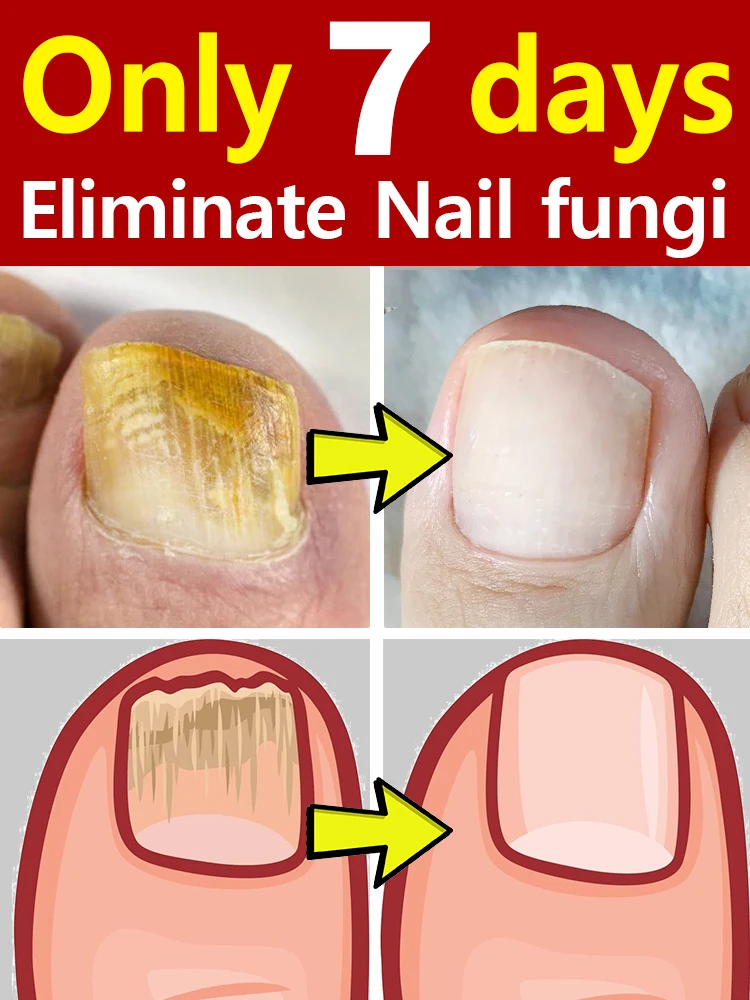 Nail problems? Solved in 7 days!
