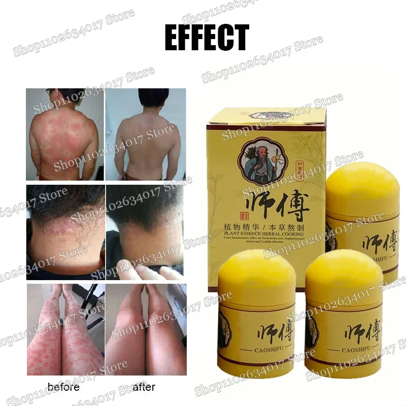 Псориаз Антибактериальный против зуда Дерматити Экзема Крапивница Алергия Кожа