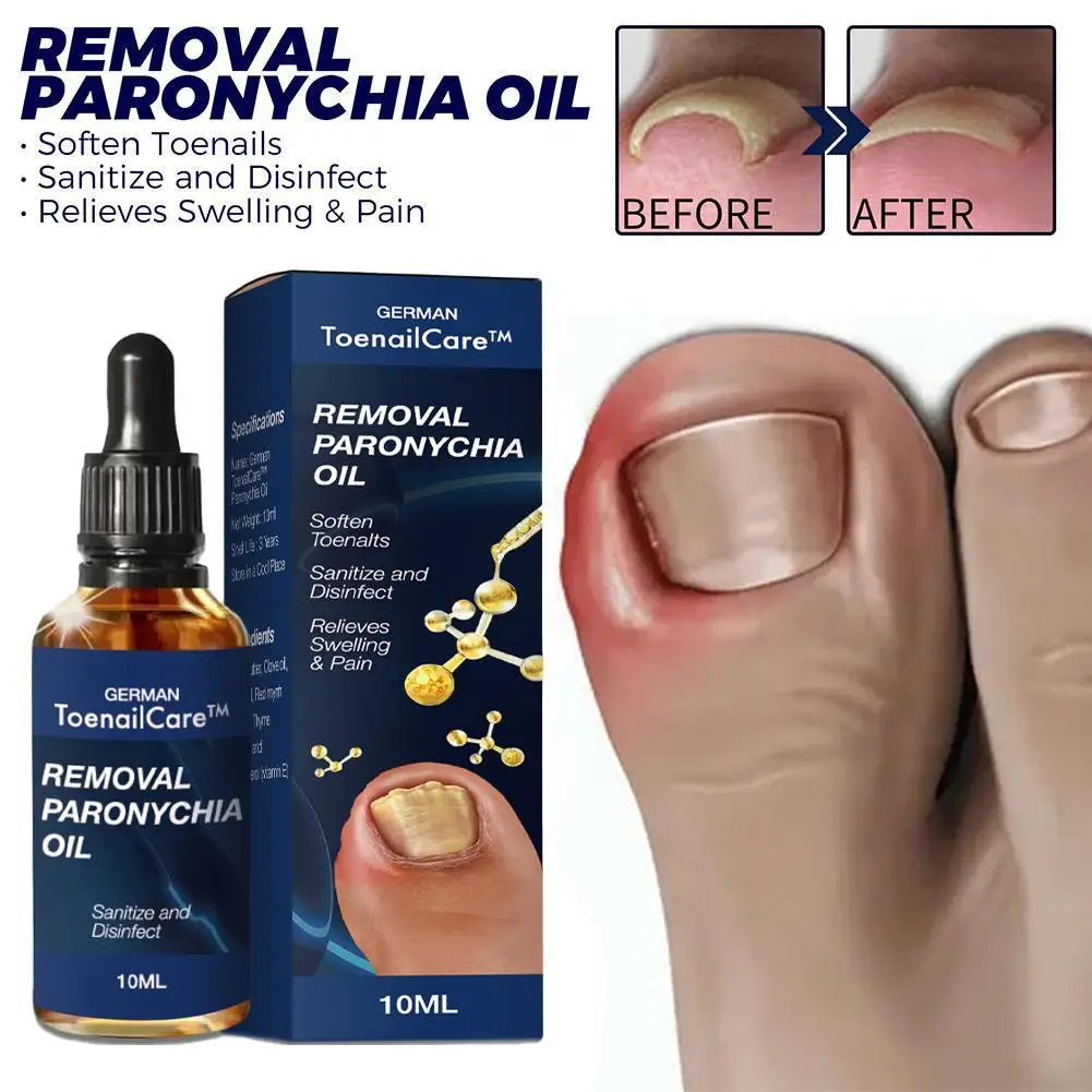 

10ml Toenailcare Removal Paronychia Oil Ingrown Toenail Treatment Best Nail Repair Solution Nail Renewal Liquid