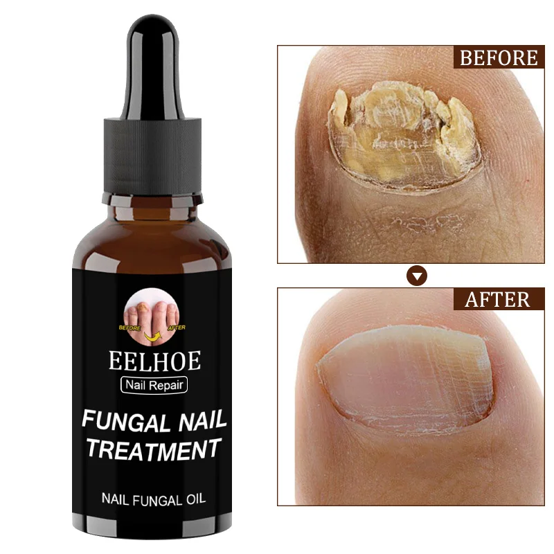 

Fungal Nail Treatment Feet Care Essence Anti Infection Paronychia Onychomycosis Repair Foot Toe Nails Fungus Removal Nourish Gel
