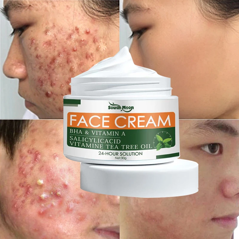 

Effective Acne Removal Face Cream Herbal Anti Acne Gel Shrink Pores Oil Control Whitening Moisturizer Acne Scar Repair Skin Care