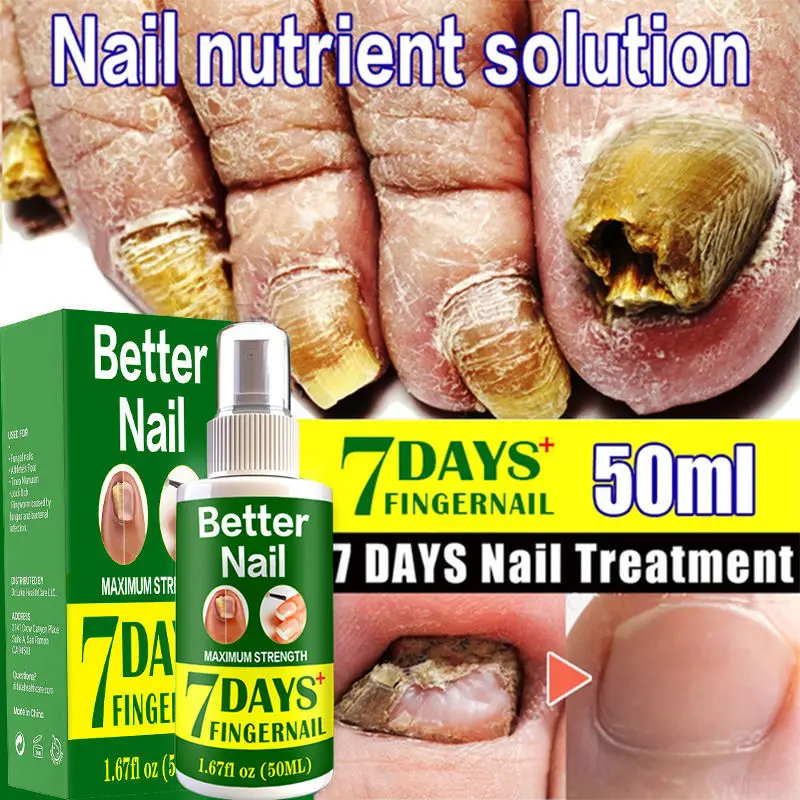 

Fungal Nail Repair Spray Nursing Treatment Foot Nail Fungus Removal Gel Anti-Infective Paronychia Onychomycosis Care