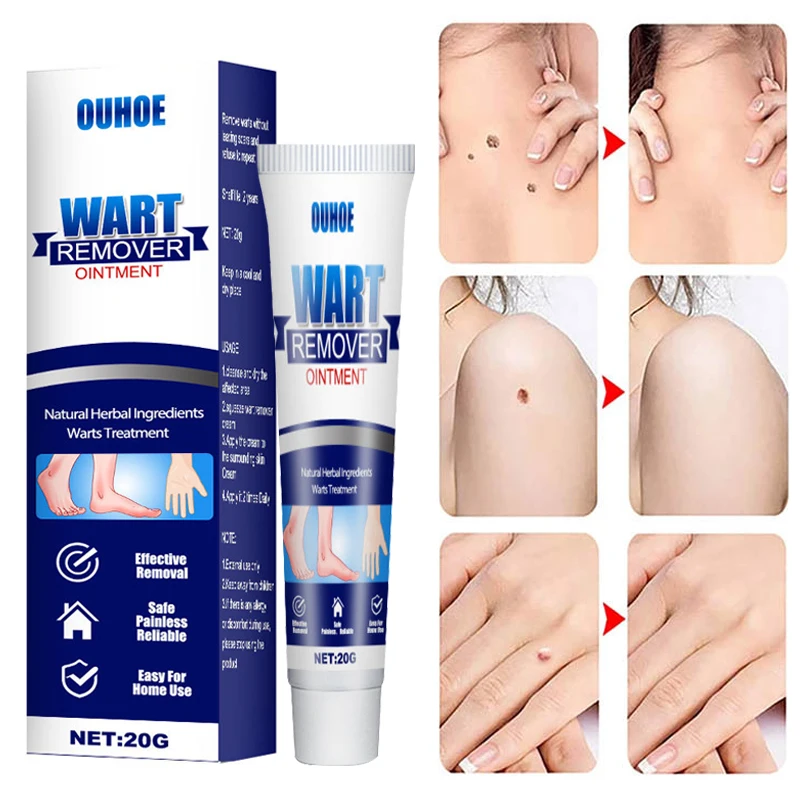 

1pc Skin Tag Warts Remover Cream Herbal Extract Body Care Skin Mole Dark Spot Foot Corn Removing Warts Treatment Cream 20g
