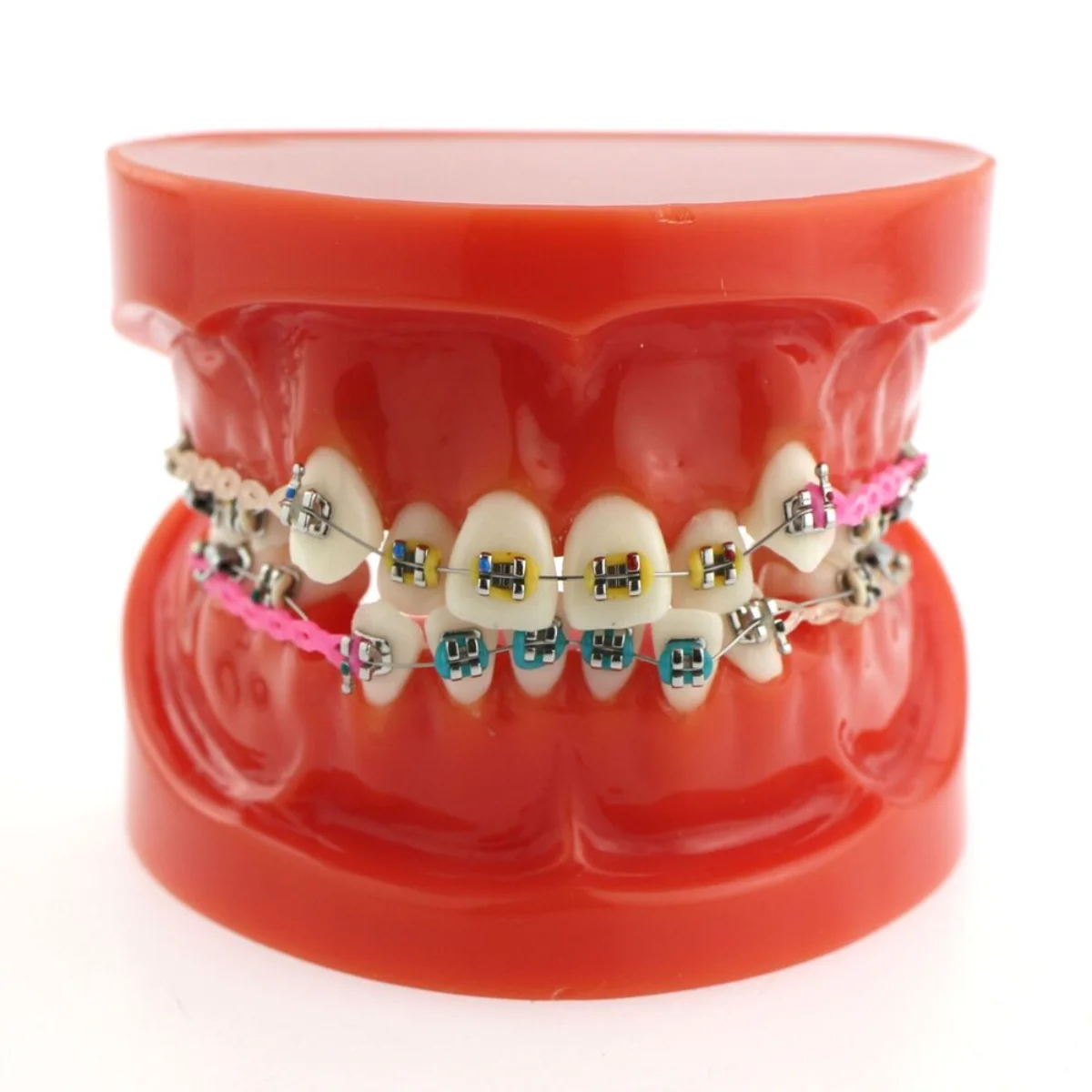 Dental Orthodontic Treatment Teeth Model Malocclusion Correction With Metal Brackets Teaching Model for Patient Demo