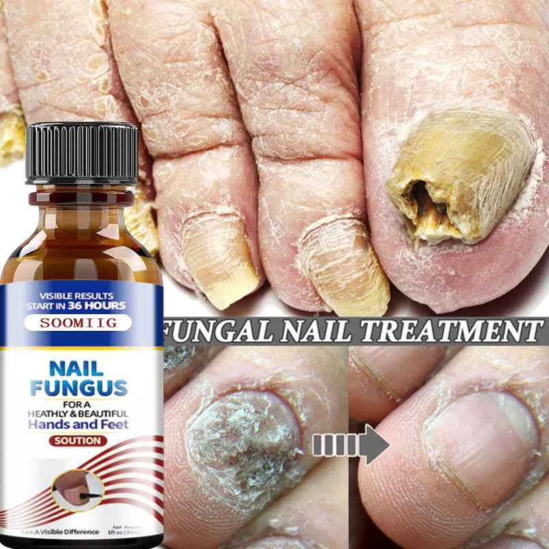 

Fungal Nail Repair,Fungal Nail Eliminator for Toenails and Fingernails,Antifungal Nails-Repairs and Renews Damaged,Broken Nails