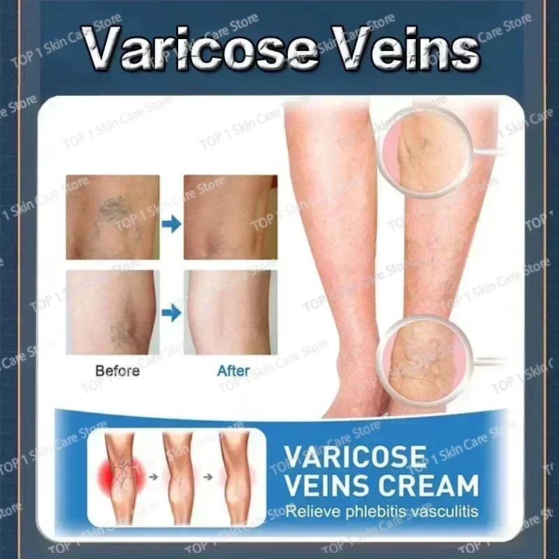 Восстанавливающий крем от варикозного расширения вен Tongmai эффективное