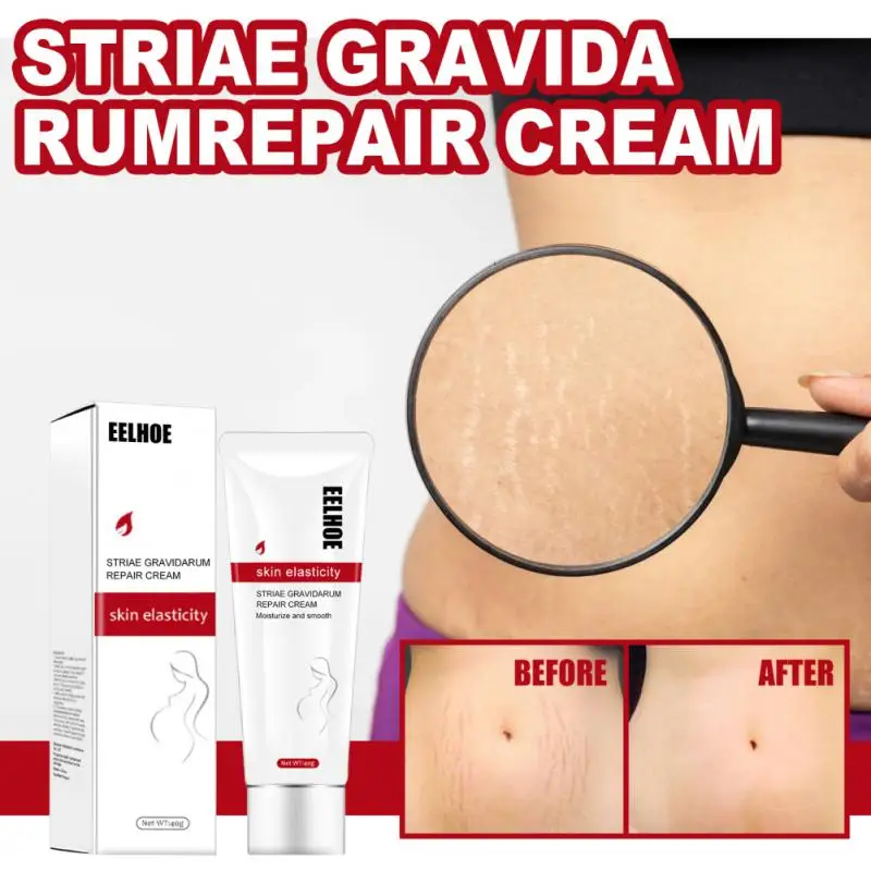 

Maternity Stretch Marks Removal Cream Body Buttock Breast Body Creams Skin Care Effective Anti White Stretch Scar Remover Cream
