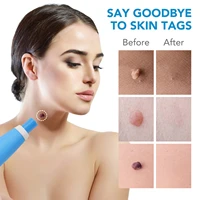 2 in 1 auto skin tag remover kit micro skin tag removal device adult mole stain wart remover face care beauty tools