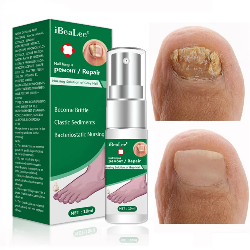 

Nail Fungus Treatment Essence Serum Hand Foot Skin Care Fungal Removal Repair Gel Anti-infective Paronychia Onychomycosis Spray